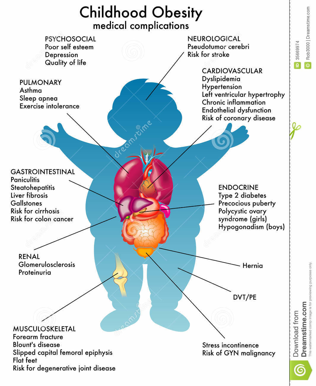 reasons-of-obesity-childhood-kidschildren