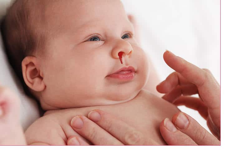 Nosebleed causes