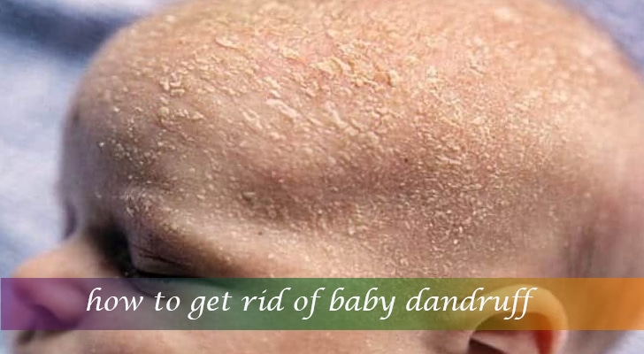 the-best-baby-dandruff-cleaning-methods-kidschildren