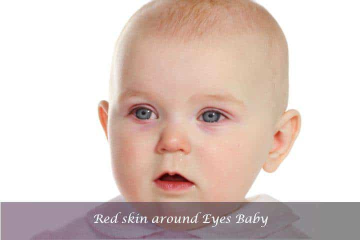 Red skin around eyes baby