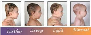 babies head shapes when to worry