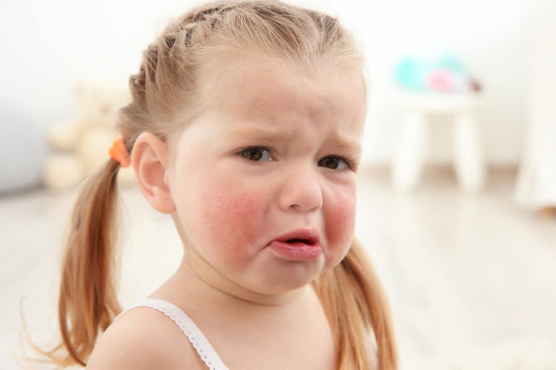 Babies food allergy symptoms (2)