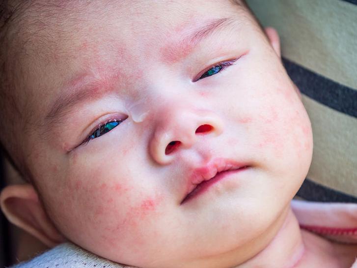 symptoms-and-pictures-of-baby-allergic-reaction-rash