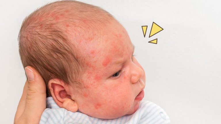 Symptoms And Pictures Of Baby Allergic Reaction Rash