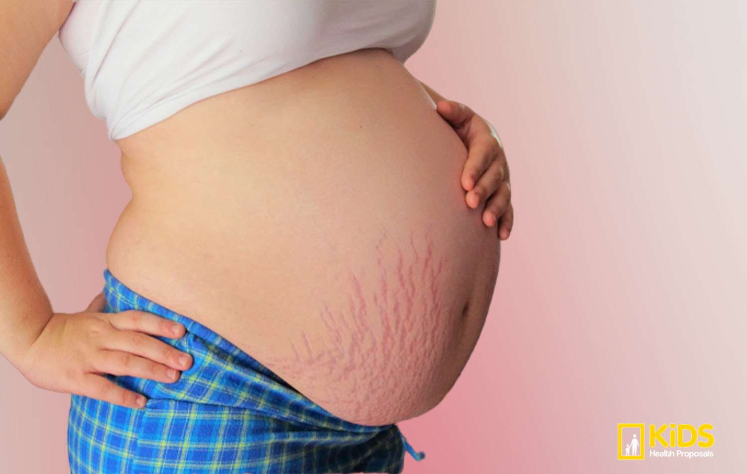 natural-remedies-for-pregnancy-stretch-marks-kidschildren