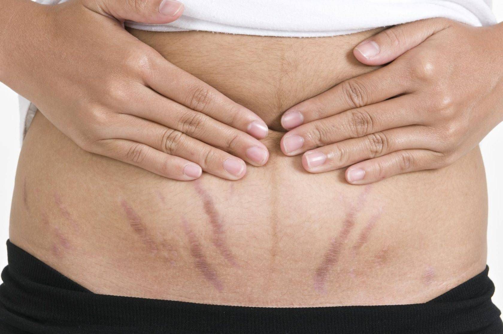 how-to-prevent-pregnancy-stretch-marks-kidschildren